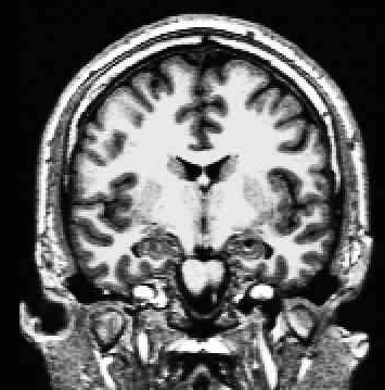 MRT-Aufnahmen des menschlichen Gehirns Magnetic Resonance Tomography (MRT) Sagittalschnitt Coronalschnitt Graue und weiße Hirnsubstanz (grey/white