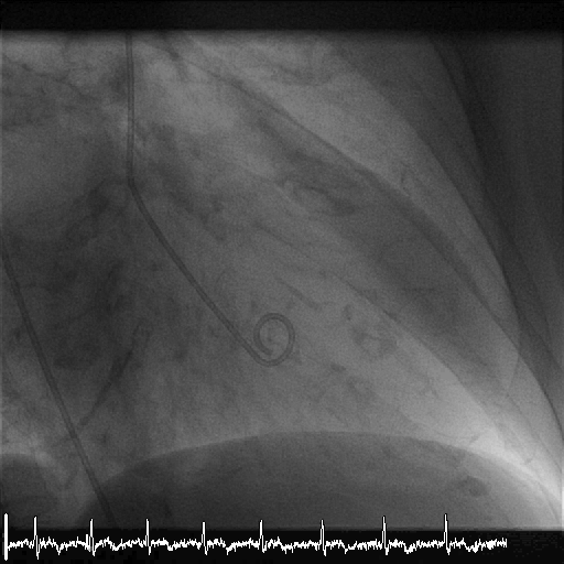 Herzinsuffizienz ClaraUpdate, 14.11.2013 PD Dr. med.