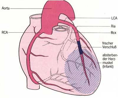 Welche Faktoren können die Leistungsfähigkeit des Herzens einschränken?
