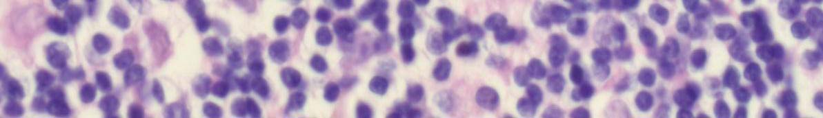Noduläres Lymphozyten-prädominantes Hodgkin-Lymphom (NLPHL) Popcorn-Zellen = LP-Zellen (Lymphozyten-