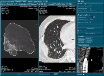 LungProjView (4) Anatomische Reformatierung