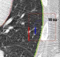 LungProjView (5) Anatomische Reformatierung II Relativ