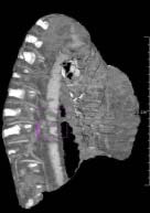 LungProjView (6) Anatomische Reformatierung