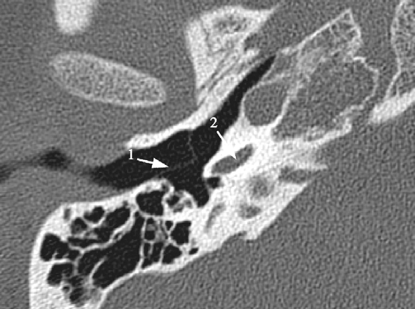 Abbildung 7: Abb. 7: Aus axialen MSCT-Bildern koronar multiplanar rekonstruierte Aufnahmen eines normalen Felsenbeins. Das Trommelfell () liegt zwischen Paukenhöhle und äußerem Gehörgang.