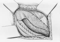 Leiste ist durch kein anatomisches Substrat gestützt. Zur Objektivierung des Leistenbruches eignet sich die Sonographie.