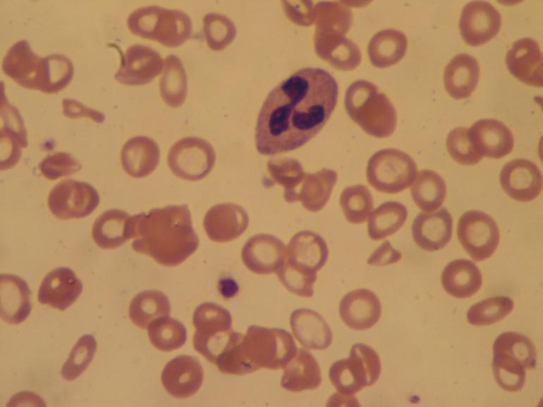 Eisenmangelanämie Anämie = tiefes Hämoglobin Typisch mikrozytäre Anämie (MCV < 85fl)