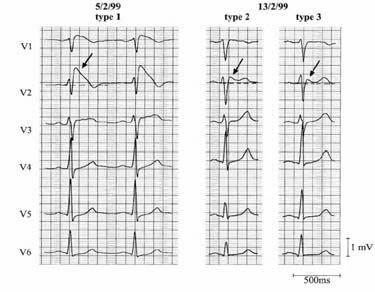 Arrhythmogene Erkrankungen im EKG Brugada-Syndrom Brugada-Syndrom Brugada-Brugada-Syndrom häufige Ursache für Kammerflimmern bei strukturell normalen Herzen Klinik: plötzlicher Herztod Synkopen