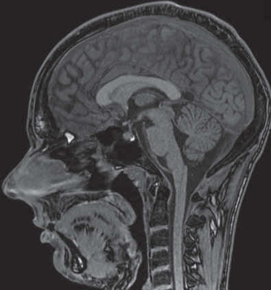 . Anatomie und Funktion Zwischenhirn (Dienzephalon) Das Zwischenhirn ist eine der bedeutendsten Strukturen des Gehirns.