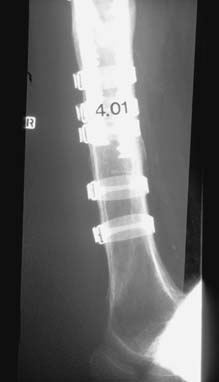 428 K. Perner 8 Wochen postoperativ war die Fraktur knöchern durchgebaut und das Bein wieder voll belastbar.