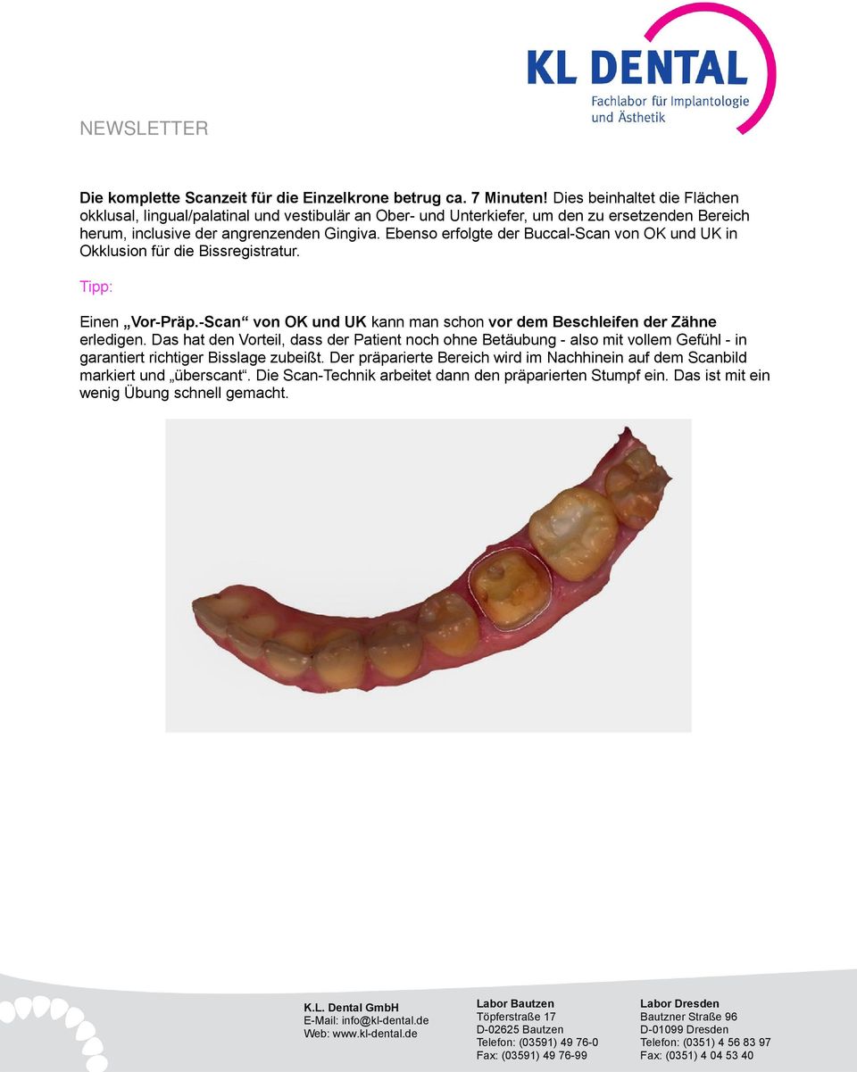 Ebenso erfolgte der Buccal-Scan von OK und UK in Okklusion für die Bissregistratur. Tipp: Einen Vor-Präp.-Scan von OK und UK kann man schon vor dem Beschleifen der Zähne erledigen.