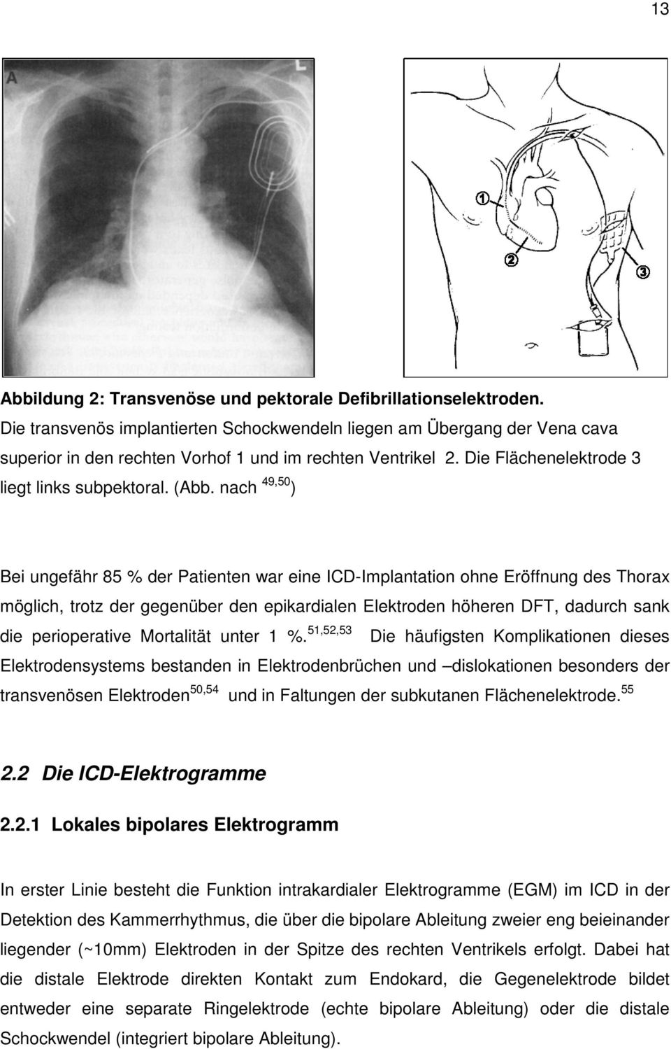 nach 49,50 ) Bei ungefähr 85 % der Patienten war eine ICD-Implantation ohne Eröffnung des Thorax möglich, trotz der gegenüber den epikardialen Elektroden höheren DFT, dadurch sank die perioperative