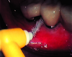 Intensivprophylaxe bei Implantaten und hochwertigem Zahnersatz Nach Eingliederung eines auf hochwertigen Implantaten verankerten, individuellen Zahnersatzes, sollten Mundhygiene und sorgfältige