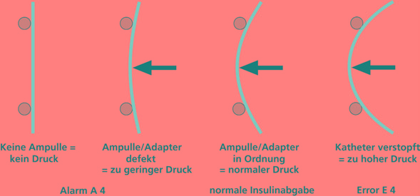 10. Insulinpumpen-Therapie und Ketoazidose 10.