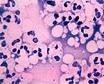 Somatische Zellen Polymorphkernige Leukozyten
