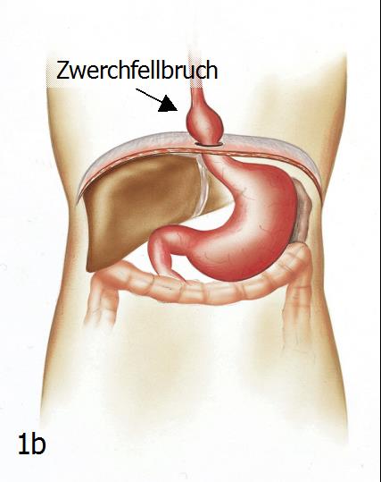 1a Abb. 1a + b: Die normale Lage von Zwerchfell, Speiseröhre und Magen (links). Bei einem Zwerchfellbruch tritt der Magen durch den Zwerchfellbruch hindurch in den Brustkorb ein (rechts).