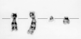 Einleitung Ebenso lassen sich Zugewinne und Verluste von einzelnen oder mehreren kompletten Chromosomen detektieren (Gibbons et al., 1992).