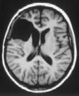 a b c d Abbildung 4: 25-jährige Patientin mit progredienten rechts-frontalen Kopfschmerzen und Antriebsminderung.