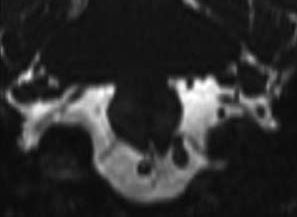 70 Canalis n. hypoglossi 1 2 Abb. 2: Wurzelfäden (1, 2, ) des N. hypoglossus beim Eintritt in den Canalis nervi hypoglossi. CISS-Sequenz, paraaxial.