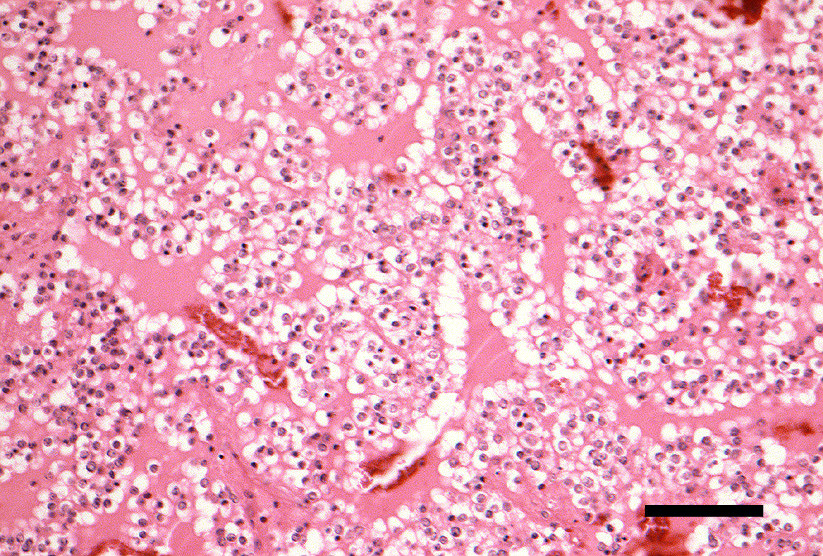 Ergebnisse Abb. 4.35: Anaplastisches Oligodendrogliom. GFAP-positive Tumorzellen mit oligodedroglialer Morphologie (Pfeile), die als gliofibrilläre Oligodendrozyten interpretiert worden sind.