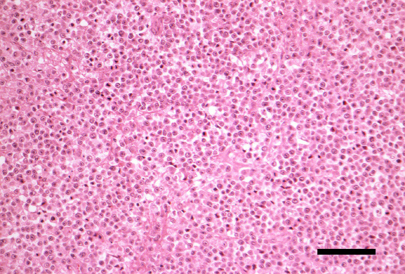 Ergebnisse Abb. 4.65: Transitionelles Meningeom mit intensiver Vimentin-Expression. Katze, Nr. 89 Nomarski-Beleuchtung, Balken = 200µm Abb. 4.66: Transitionelles Meningeom mit mäßig intensiver CEA-Expression in einzelnen Tumorzellen.
