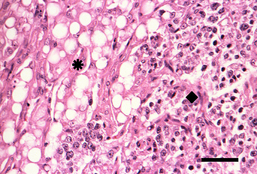 Ergebnisse Abb. 4.71: Mikrogliomatose mit teilweise parallel angeordneten hyperchromatischen Kernen. Hund, Nr. 106 H.E.-Färbung, Balken = 50µm Abb. 4.72: Maligne Histiozytose bestehend aus pleomorphen, histiozytären Zellen.