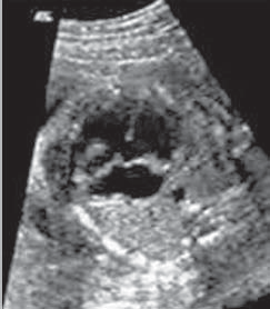 RV LV Abb. 5: Pränatales Ultraschallbild eines Herzens mit AVSD in der 26. Schwangerschaftswoche.