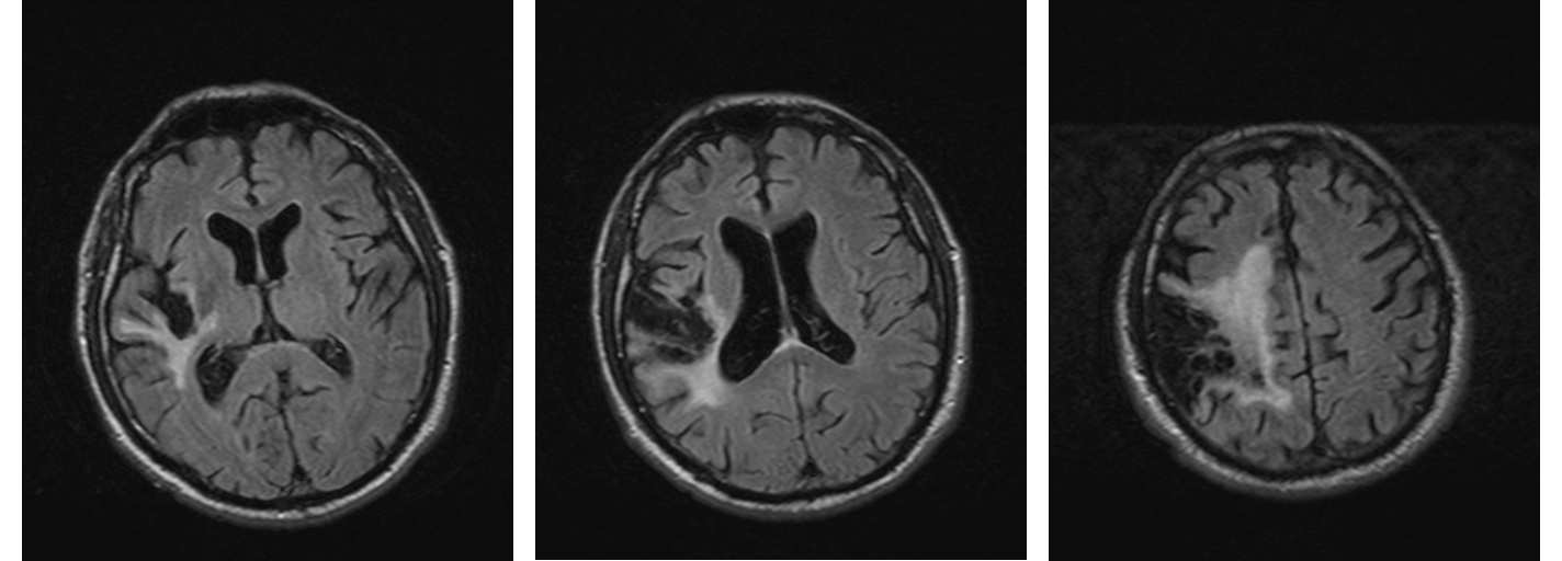 1.7. Zerebrale MR-Bildgebung 1.7. Zerebrale MR-Bildgebung Die zerebrale Bildgebung eignet sich zum Nachweis relevanter intrakranieller Gefäßstenosen, mikroangiopathischer Veränderungen und zur