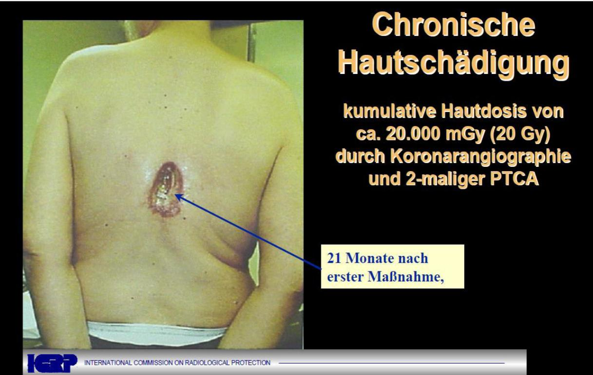 Deterministische Strahlenschäden Stochastische Strahlenschäden Als stochastische Strahlenschäden bezeichnet man Krebserkrankungen und vererbbare genetische Defekte Stochastische Strahlenschäden haben