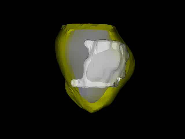Nachweis von Ventrikelnarben mittels Kardio MRT Cine MRI enables 3D+t reconstruction of