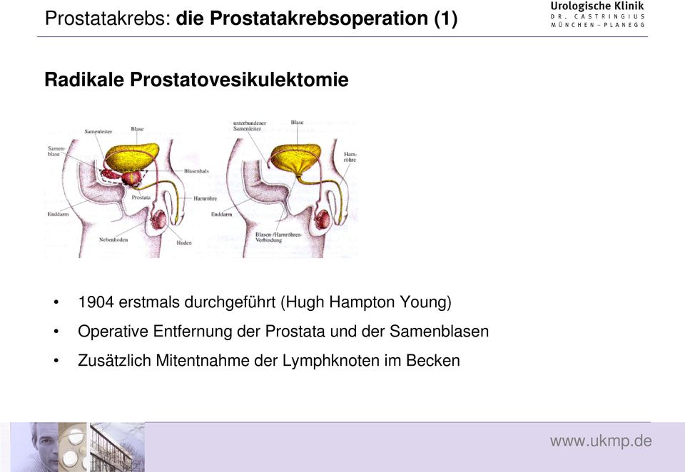 Hampton Young) Operative Entfernung der Prostata und der