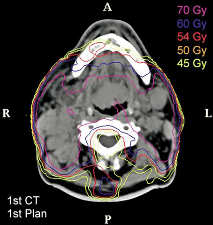 ... mit dosimetrischen Folgen! Adaptive Radiotherapie Grégoire et al.