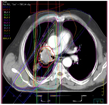 Abbildung 4.6: Planungs-CT eines Patienten mit einem rechts-zentralen NSCLC, transversale Schicht in Höhe der Trachealbifurkation.