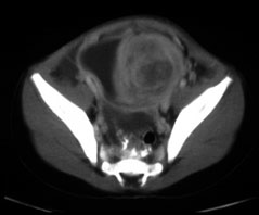 Abbildung 2b: Embryonales Rhabdomyosarkom, von der Blasenwand ausgehend, bei einem dreijährigen Knaben. Abbildung 2a: Alveoläres Rhabdomyosarkom, parapharyngeal, rechts, bei einem Kleinkind.