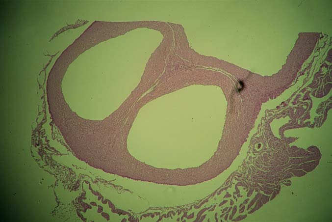 Abb. 12: unten: rechtes Atrium mit Klappensegel, rechts: Unterkreuzung des linken Aortenbogens durch den rechten Aortenbogen, oben: Einmündung des