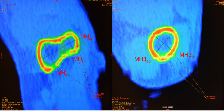 Abb. 32: Markhöhlendurchmesser des Humerus, dargestellt am mazerierten Knochen (oben) und im CT-Scan (unten) 1: Humerus, Anschnitt 1 cm proximal (links) und 3 cm proximal (rechts) des Condylus humeri
