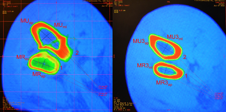 Abb. 35: Markhöhlendurchmesser von Radius und Ulna, dargestellt im CT-Scan 1: Radius im Querschnitt 2: Ulna im Querschnitt MR ap und MR ml : Markhöhlendurchmesser 1 cm distal der Fovea capitis radii