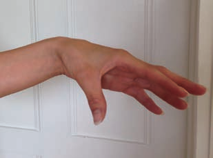 Atypische Parkinson-Syndrome Abb. 5 Handhaltung bei Dystonie. Links: Entspannte Handhaltung bei einer Patientin mit Dystonie.