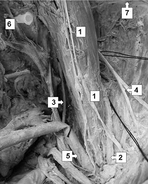 21 Abbildung 8: Darstellung des M. psoas major [1], des N. femoralis [2], des N. obturatorius[3] und des N. cutaneus femoris lateralis[4] sowie der A.