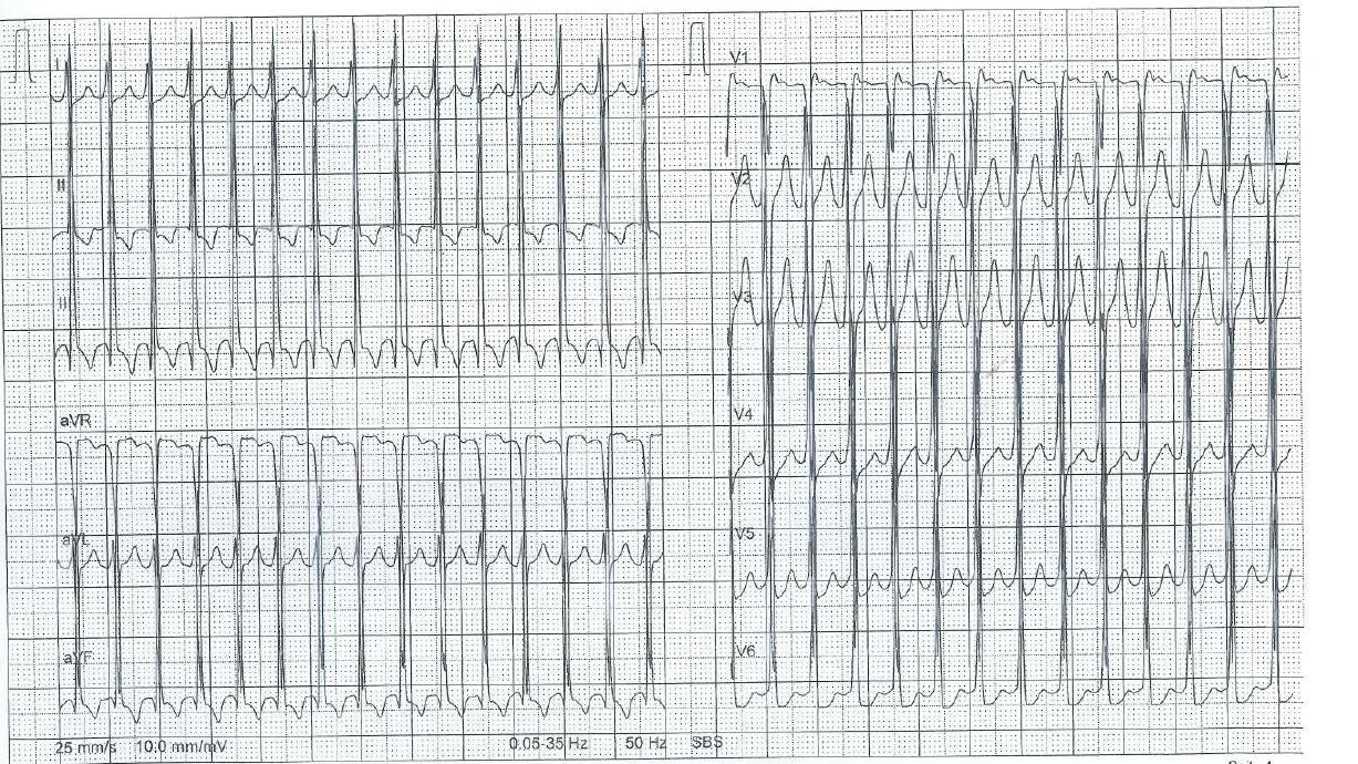 Beispiel 1 33-jähriger Patient mit Herzrasen, BD 110/70, SpO2 95% 1. Ist eine elektrische Aktivität vorhanden? 2. Schnell oder langsam? 3. QRS regelmässig oder unregelmässig?