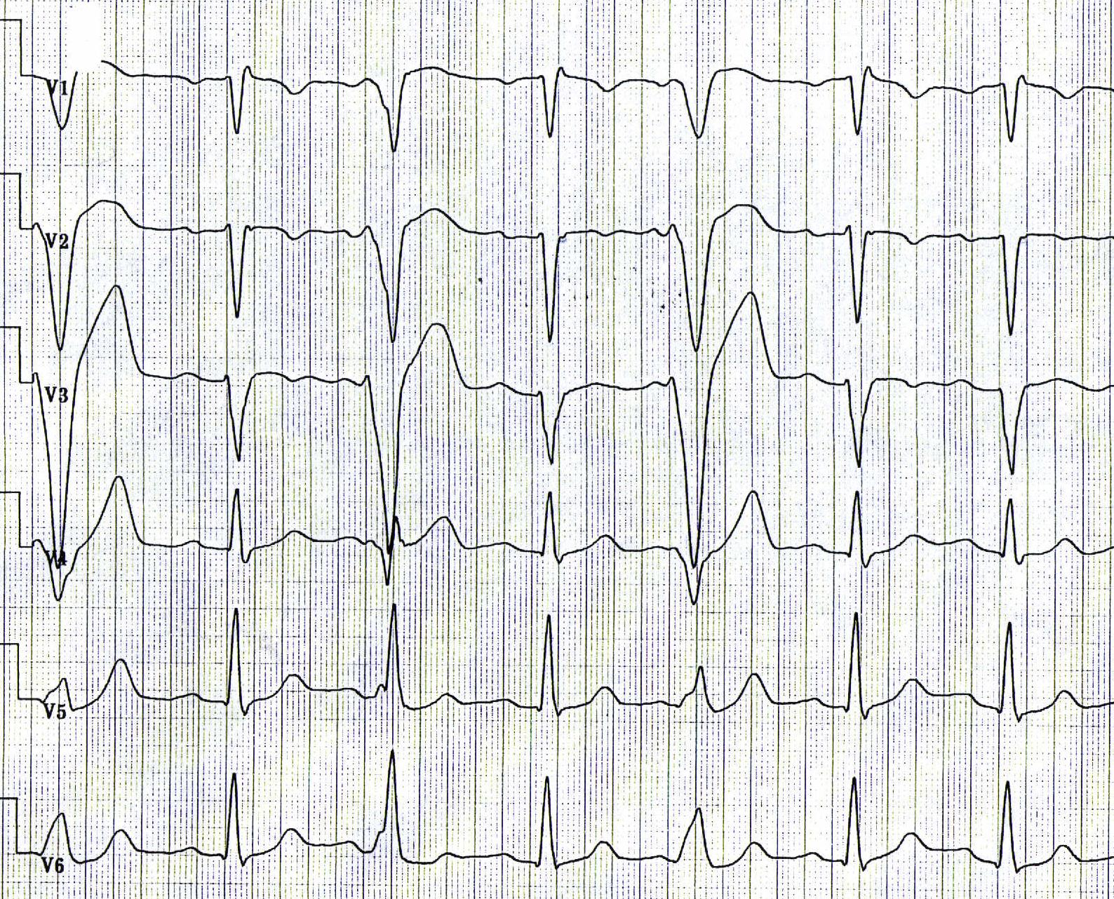 Ruhe-EKG mit 50 mm/sec QRS 110 ms in V1 Epsilonpotential T