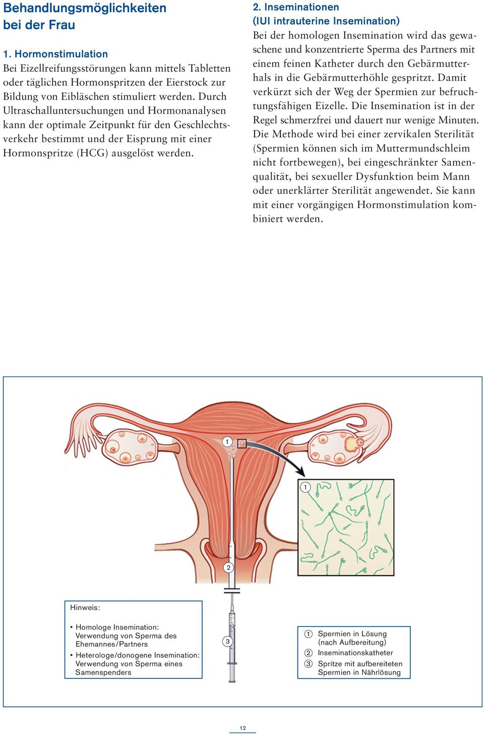 Inseminationen (IUI intrauterine Insemination) Bei der homologen Insemination wird das gewaschene und konzentrierte Sperma des Partners mit einem feinen Katheter durch den Gebärmutterhals in die