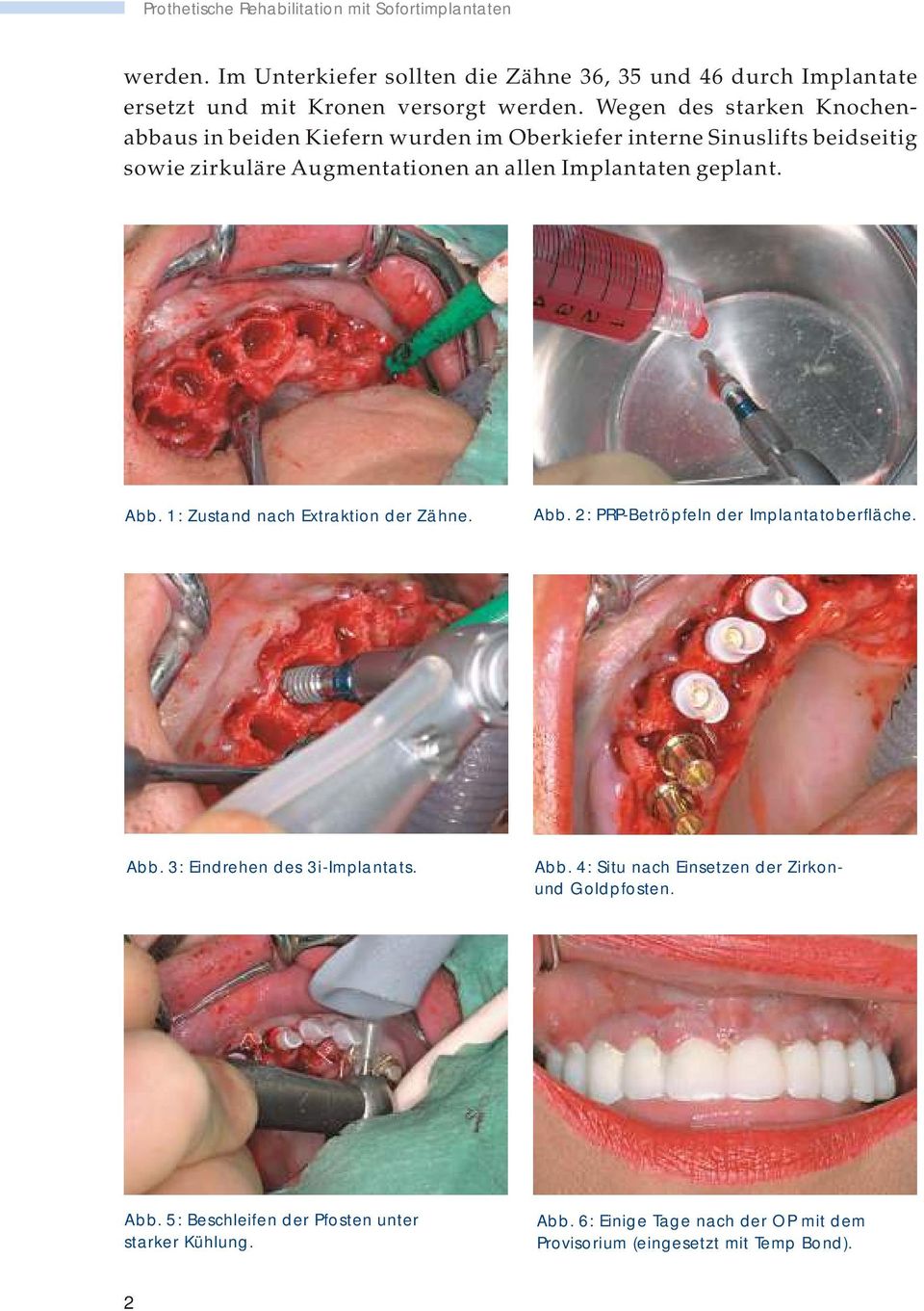 Abb. 1: Zustand nach Extraktion der Zähne. Abb. 2: PRP-Betröpfeln der Implantatoberfläche. Abb. 3: Eindrehen des 3i-Implantats. Abb. 4: Situ nach Einsetzen der Zirkonund Goldpfosten.