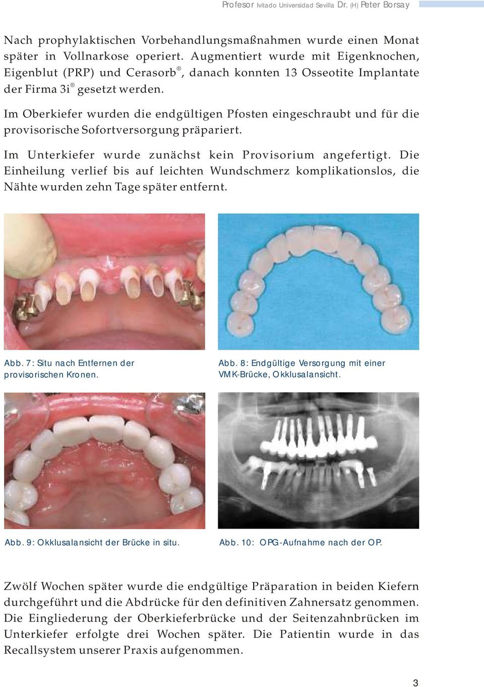 Im Oberkiefer wurden die endgültigen Pfosten eingeschraubt und für die provisorische Sofortversorgung präpariert. Im Unterkiefer wurde zunächst kein Provisorium angefertigt.