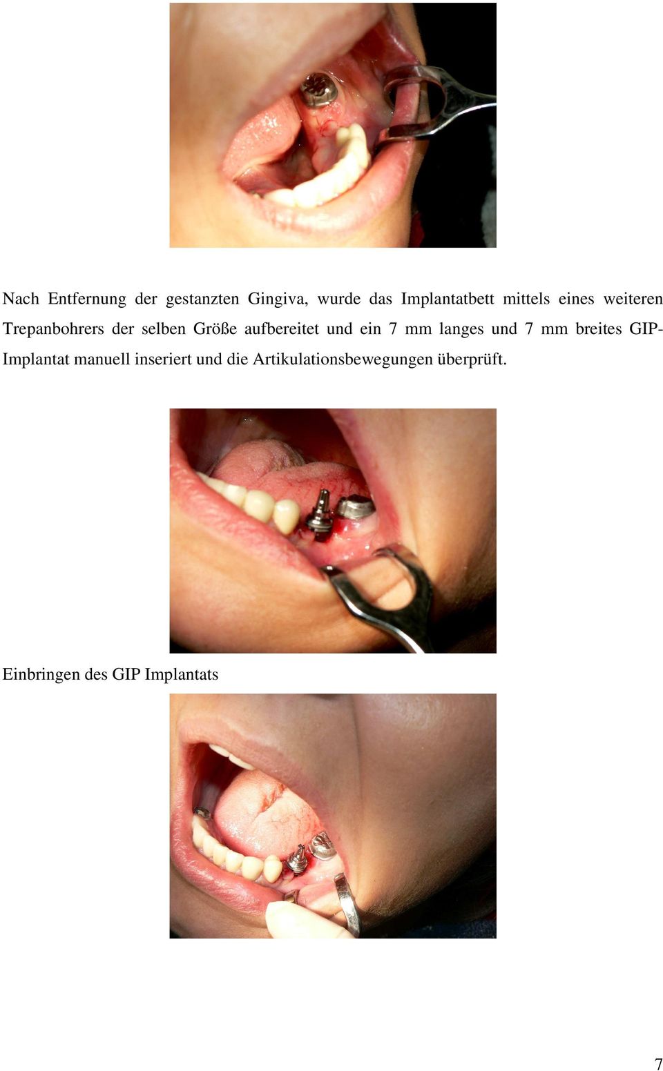 und ein 7 mm langes und 7 mm breites GIP- Implantat manuell