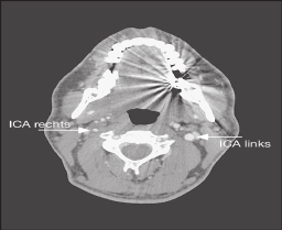 a b c Abbildung 1: Fallbeispiel eines 40-jährigen Patienten mit langstreckiger Dissektion der Arteria carotis interna (ICA) rechts.