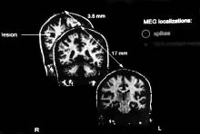 Im Forschungsstadium befinden sich Programme oder Datenbanken, welche kernspintomographische Bilder, Röntgenbilder oder Bildmaterial allgemein mit den EEG-Daten verknüpfen.