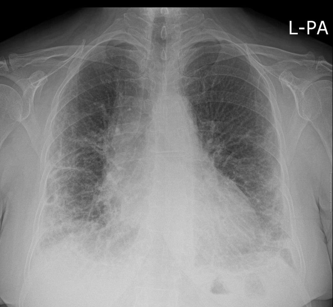 Interstitielle Lungenerkrankungen Röntgenübersichtsbild - Feinstreifig-retikuläres Muster, daß von