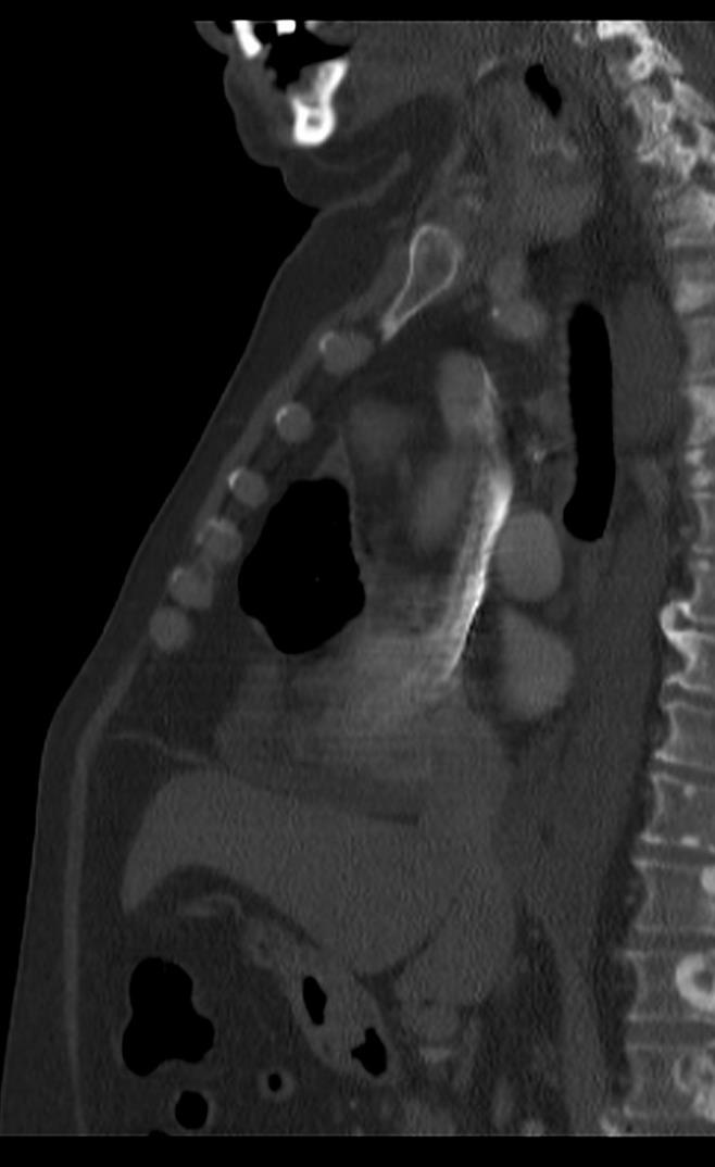 Mediastinum Krankheiten des Mediastinums manifestieren sich als Mediastinalverbreiterung oder Mediastinalverlagerungen.