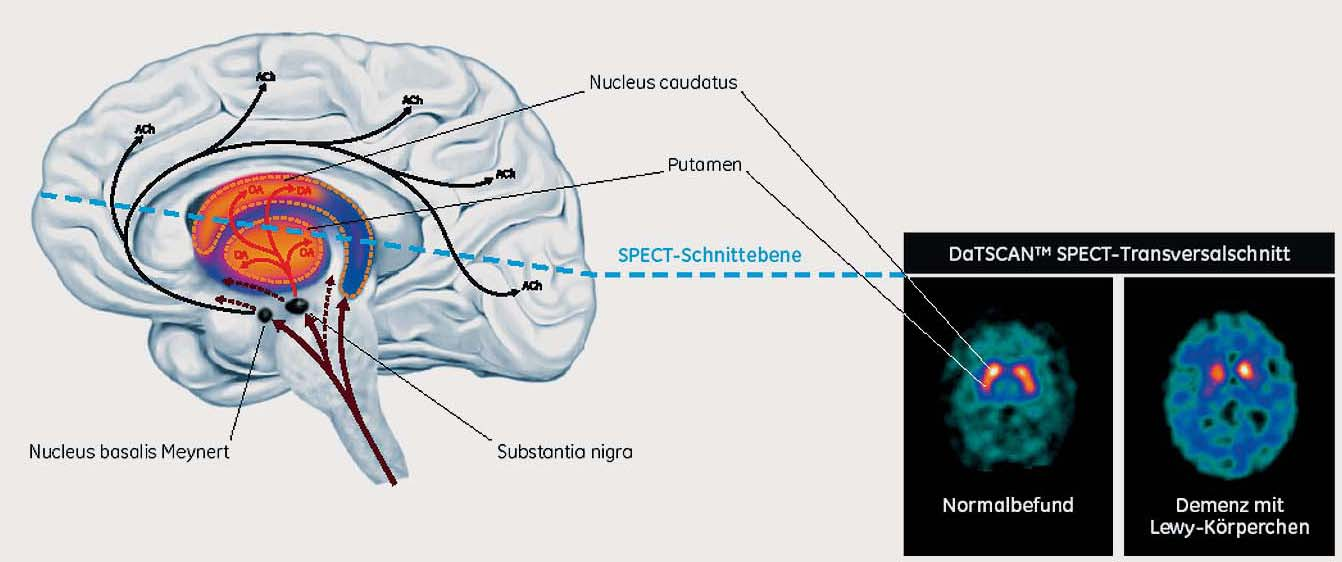 Asymptomatische Phase Asymptomatische Phase Diagnose kann klinisch noch nicht