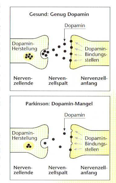 Dopaminproduzierende Nervenzellen gehen also durch Zelltod zu
